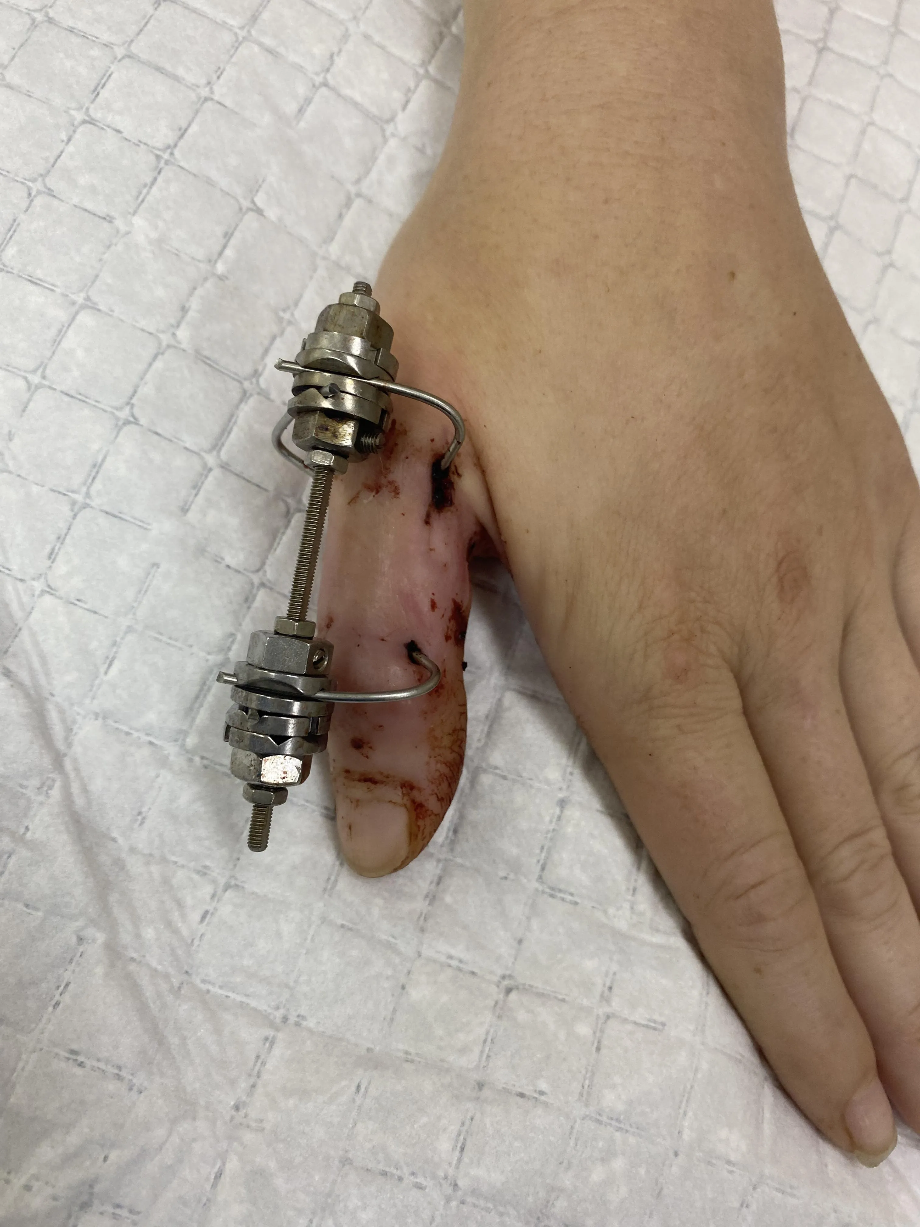 Фиксация переломов костей кисти